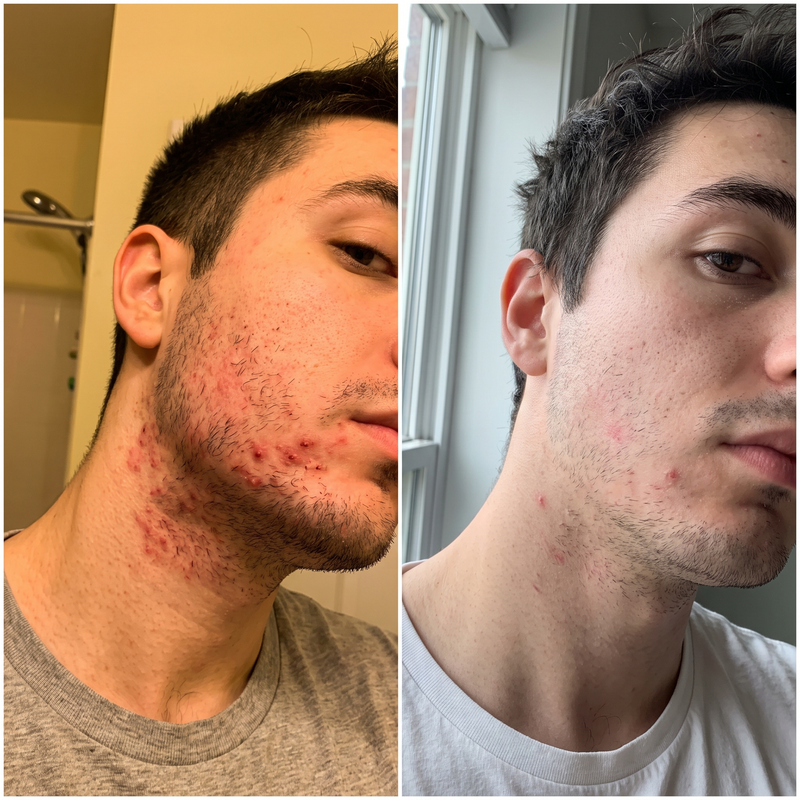 Razor burn