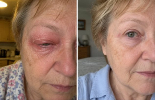 Before and after: red, swollen eyelid, then calm skin